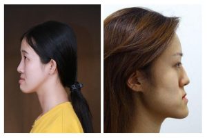 Nhìn nghiêng, phần cằm có xu hướng đưa về phía trước khiến mặt bị gãy