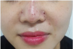 Dấu hiệu tiêm filler bị hoại tử có thể nhận thấy bằng mắt thường