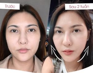 Khuôn mặt trở nên thanh thoát, cân đối hơn sau khi tiêm filler tại Seoul Center