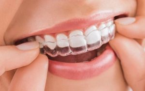 Đeo khay niềng từ 20 – 22 giờ/ngày để đảm bảo hiệu quả