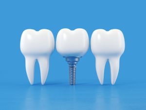 Trồng răng Implant có giá dao động từ 110 - 150 triệu đồng/ hàm