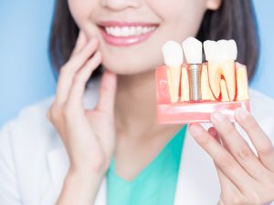 Trụ răng Implant sau khi cấy ghép vào cung hàm có thể có tuổi thọ lên đến hơn 25 năm