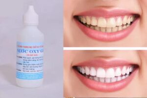 Oxy già giúp làm trắng răng khá hiệu quả