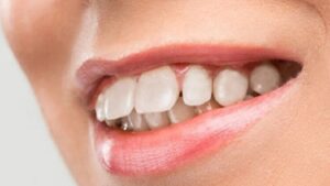 Các phương pháp khắc phục mặt hô nhẹ tại nhà