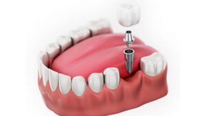 Khi niềng răng sẽ hạn chế việc phải trồng răng, mang lại lợi ích cho sức khỏe răng miệng.