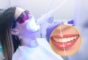 Sau khi tẩy trắng, răng cần được chăm sóc, bảo vệ thời gian đầu