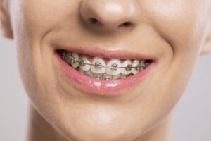 Niềng răng mắc cài kim loại