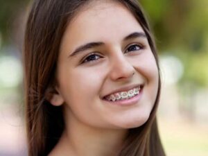 Niềng răng mắc cài chữa tình trạng mặt móm hiệu quả