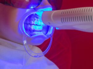 Bạn nên thực hiện tẩy trắng răng laser nếu muốn sở hữu hàm răng trắng sáng