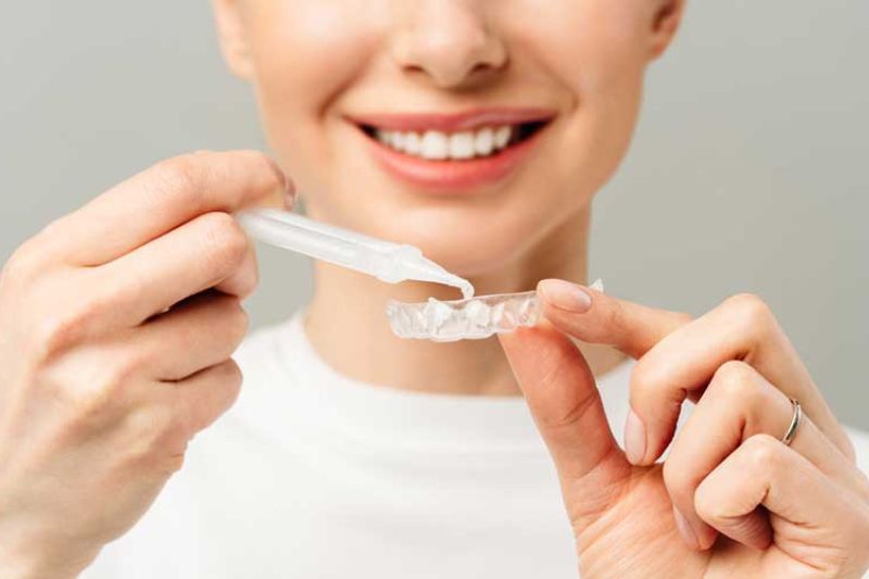 Ngậm máng tẩy trắng răng có thể thực hiện tại nhà theo chỉ định của bác sĩ