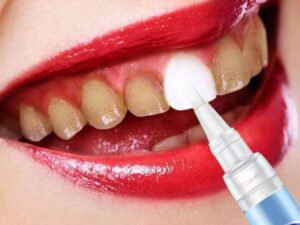 Ưu điểm nổi bật của bút làm trắng răng là có tính tiện lợi, giá rẻ