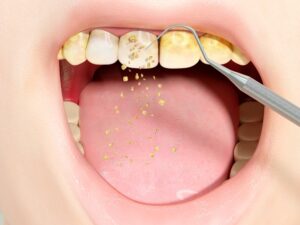 Bạn nên thực hiện lấy cao răng thường xuyên, định kỳ để làm sạch răng miệng