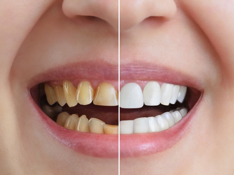 Những người có răng xỉn màu nên làm trắng răng với dâu tây