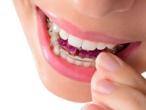 Niềng răng mắc cài phía trong hạn chế tổn thương môi, má khi chẳng may bị va đập