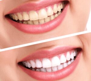 Bọc sứ giúp khắc phục hoàn toàn răng nhiễm Tetracycline