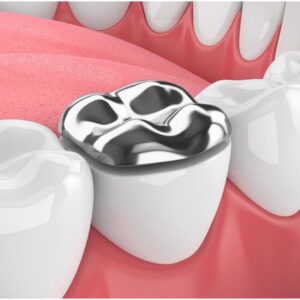 Thay trám mới giúp khắc phục trám cũ ố vàng, xuống màu hiệu quả