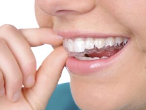 Máng tẩy trắng răng an toàn với sức khỏe người dùng