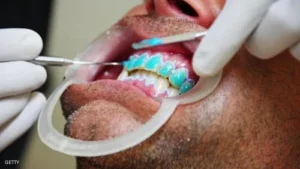 cắt mí mắt không nhắm được