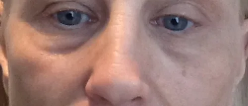 Under eye filler injection