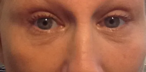 Đối tượng nào phù hợp tiêm filler bọng mắt?