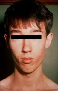 receding chin malocclusion