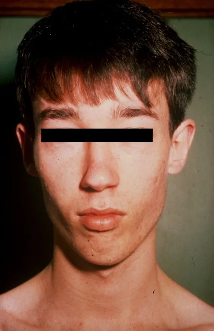 receding chin malocclusion