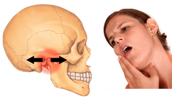 Mặt lệch do đau khớp thái dương hàm là biểu hiện của bệnh gì?