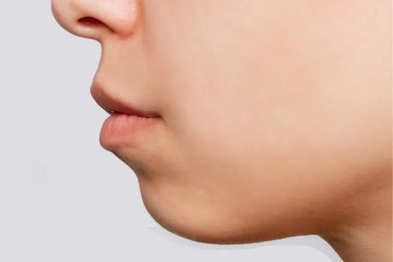 Cằm lẹm và khớp cắn là gì