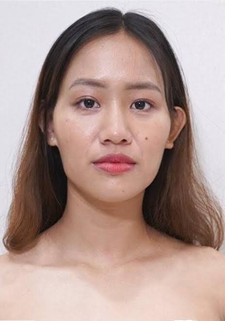 Gò má cao và thái dương hóp