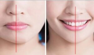 Cằm lệch sang một bên phải làm sao