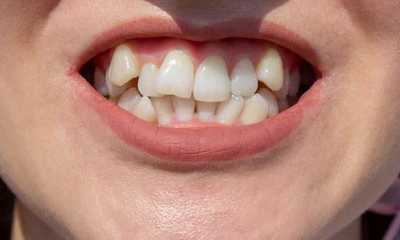 Mất răng gây hàm co lại bên một phía
