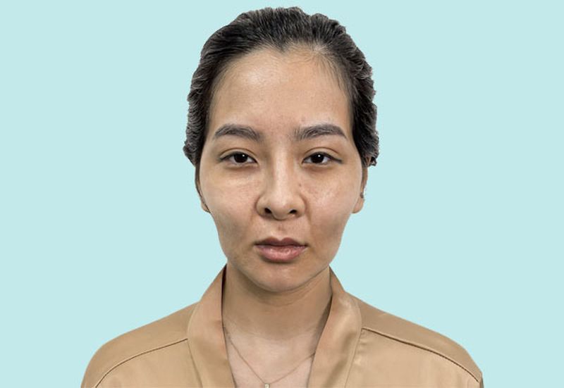 Thái dương lõm hóp