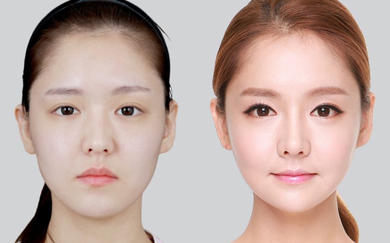  Tiêm Filler là gì? 