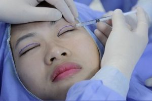 Cắt mí có được uống trà không?