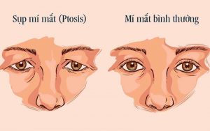 Sụp mí mắt khiến mắt trông mất thẩm mỹ