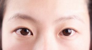 Tướng mắt 2 mí ẩn khiến đôi mắt trông nhỏ, hẹp, thiếu sức sống