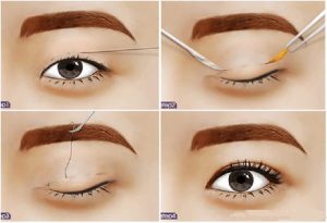 Nhấn mí dù là tiểu phẫu nhưng bạn cũng cần phải kiêng cữ khá nhiềuNhấn mí dù là tiểu phẫu nhưng bạn cũng cần phải kiêng cữ khá nhiều