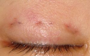 Dấu hiệu nhận biết nhấn mí lòi chỉ