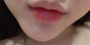 Biến chứng tiêm filler cằm khi chọn nhầm địa chỉ làm đẹp