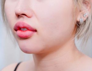 Tiêm filler cằm tròn tài lộc mang đến may mắn cho chị em