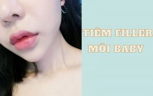 Tiêm filler môi baby là phương pháp làm đẹp thời thượng