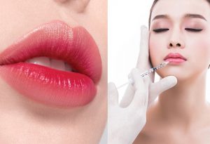 Bạn đã biết gì về tình trạng tiêm filler xong môi bị lệch?