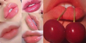Tiêm filler môi cherry – Tăng sức hút cho đôi môi căng mọng