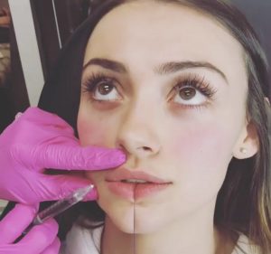 Tiêm filler môi tây mang vẻ đẹp quyến rũ đến mọi cô gái