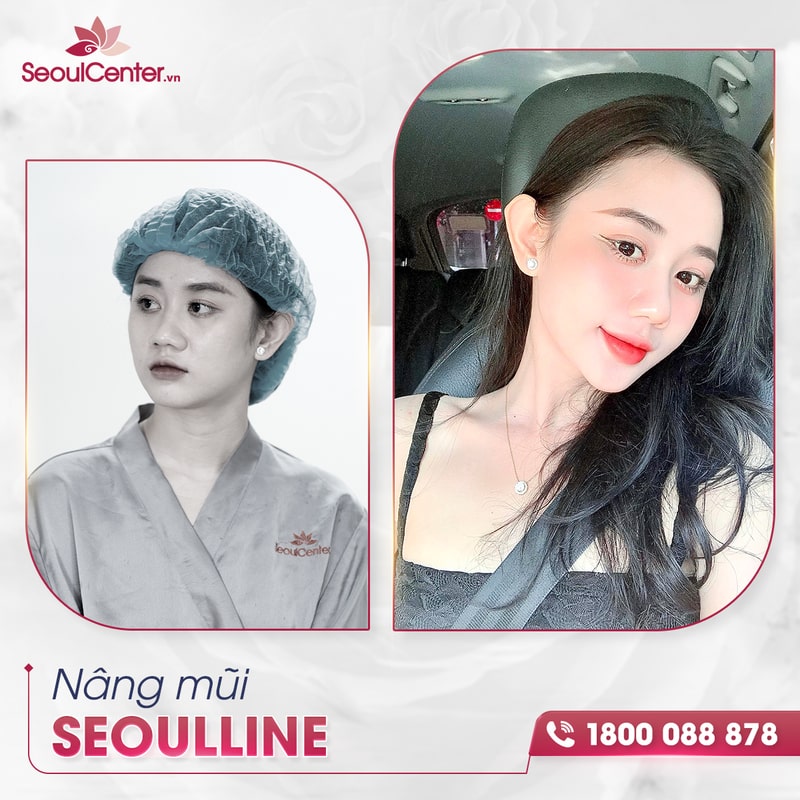 Gương mặt rạng ngời, xinh đẹp với chiếc mũi mới