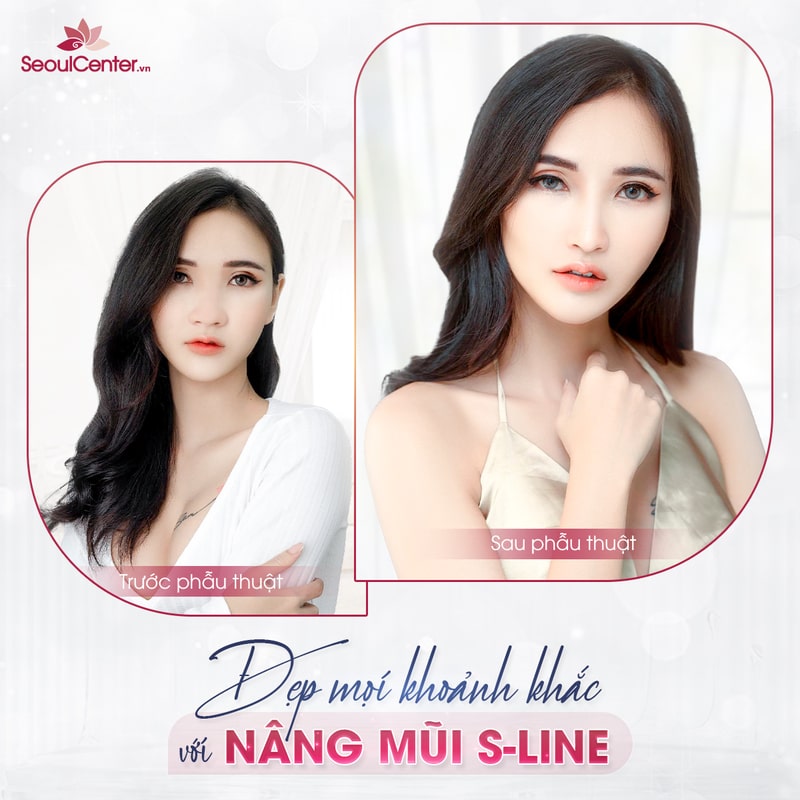 Khắc phục mọi khuyết điểm tại mũi với công nghệ S-Line độc quyền