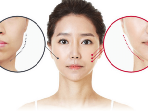 Thay vì phẫu thuật chỉnh hình tốn nhiều thời gian thì tiêm botox giúp tiết kiệm thời gian