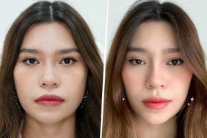 Tiêm botox gọn hàm giúp bạn sở hữu gương mặt thanh thoát, nữ tính