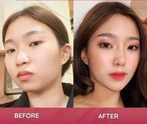 Nâng mũi cấu trúc là phương pháp phù hợp nhất với những người bị viêm xoang