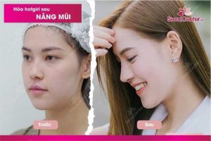 Nhan sắc chuẩn hot girl của khách hàng với chiếc mũi cao thanh thoát